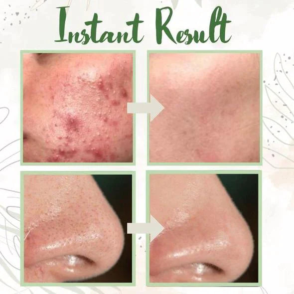 🔥Last Day 49% OFF -🌿Green Tea Deep Cleanse Mask - Gentle. Effective. All-Natural