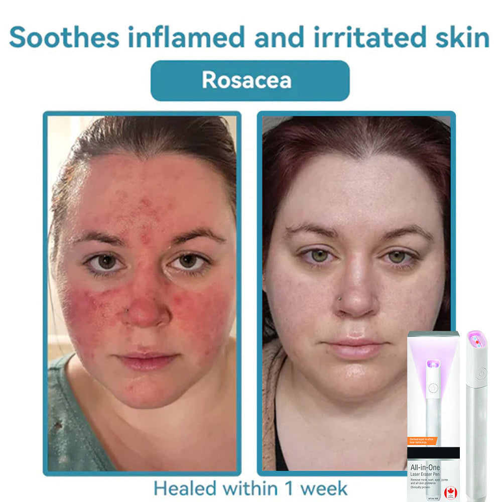 ✨All-in-One CO₂ Laser Eraser Pen | Removes Moles, Warts, Skin Flaws & Pigmentation